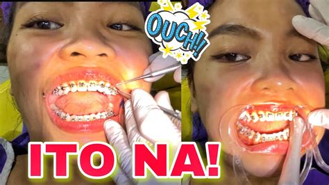 naka brace porn|Pinay Na Naka Brace Porn Videos .